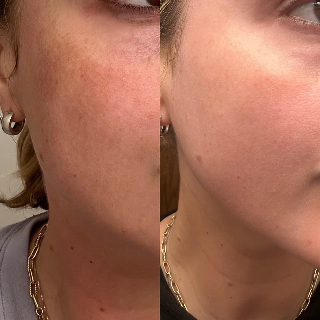 ✨ Real Results. Real Glow. ✨ Peep this stunning Lase MD Ultra before & after! Clearer skin, smoother texture, and that h...Beauty Giveaways by Womens-Resources